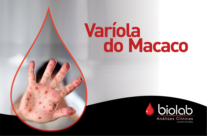 O que você precisa saber sobre a Varíola do Macaco