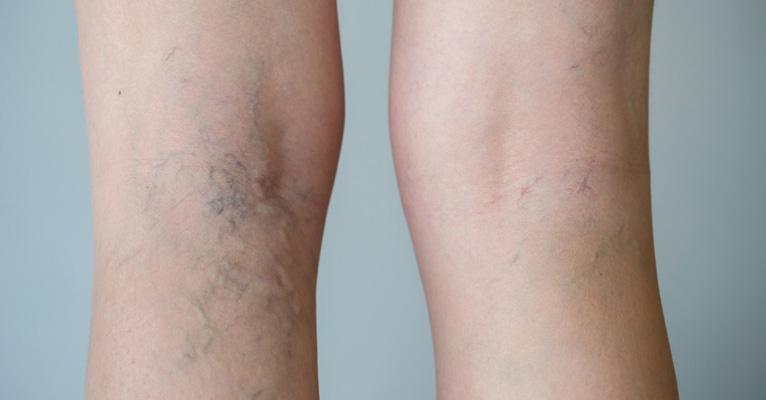 Varizes: fatores de risco e prevenção
